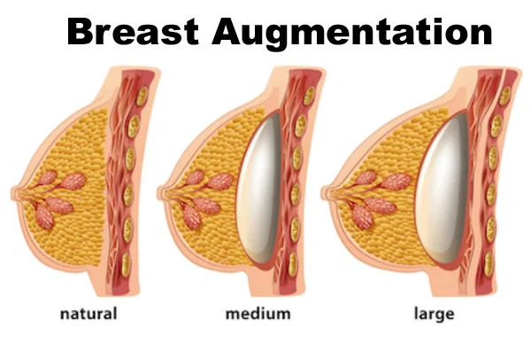 Breast Enlargement